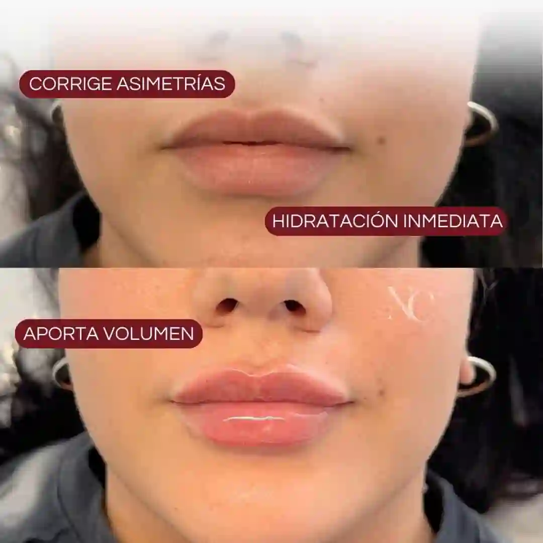 Antes y despues diseño de labios Salta