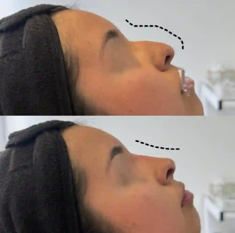 Antes y despues rinomodelacion salta